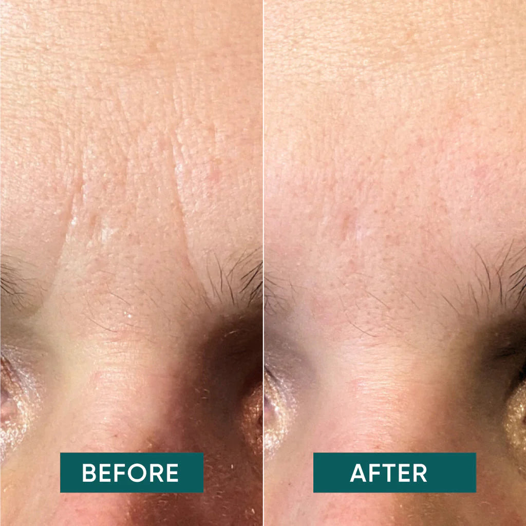 Ontspan je fronslijnen en verwen je huid: De zachte patches van Apricot, gemaakt van hoogwaardig katoen en verrijkt met hydraterende Hyaluronzuur. Dermatologische tests laten zien dat rimpels al na de eerste keer gebruik zichtbaar verminderen.