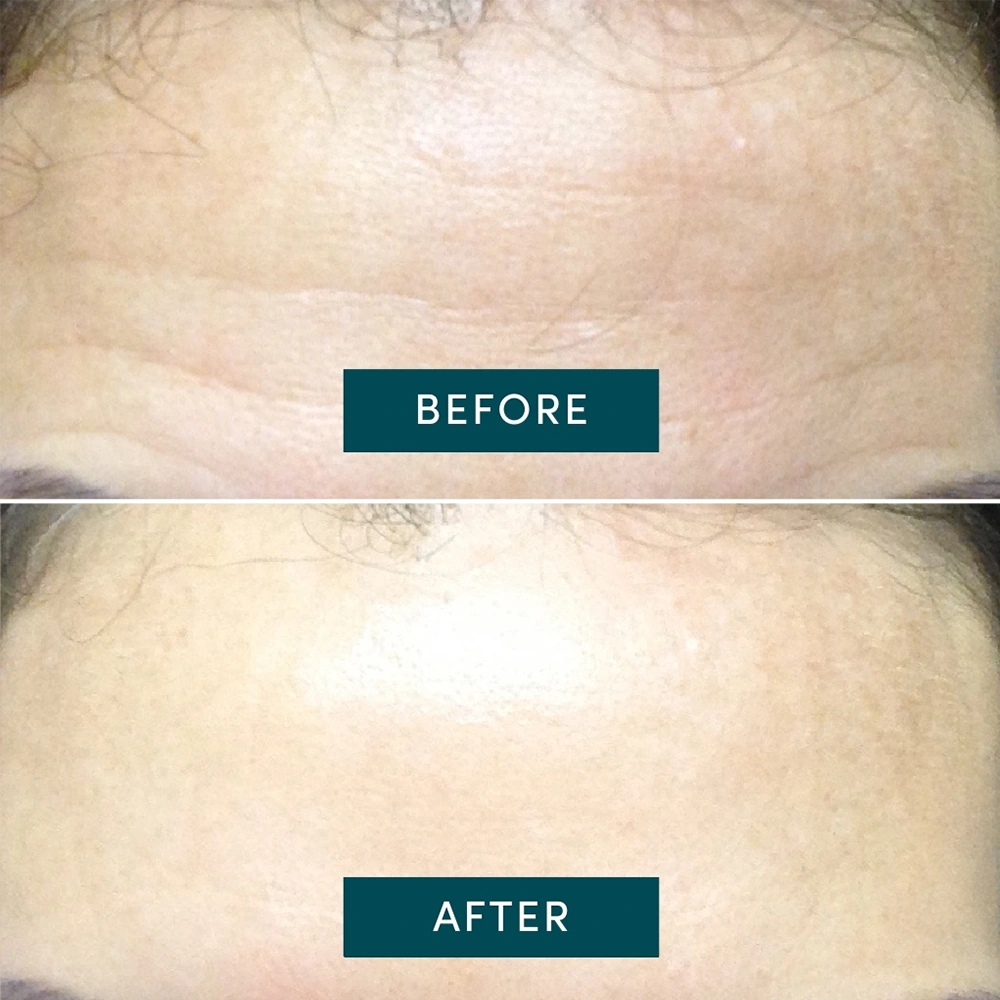 Forehead Pad Hexapeptide - Timeless you